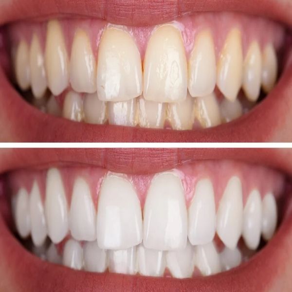 ژل سفید کننده دندان هلو اسمایل مدل 3D care حجم 50 میلی لیتر