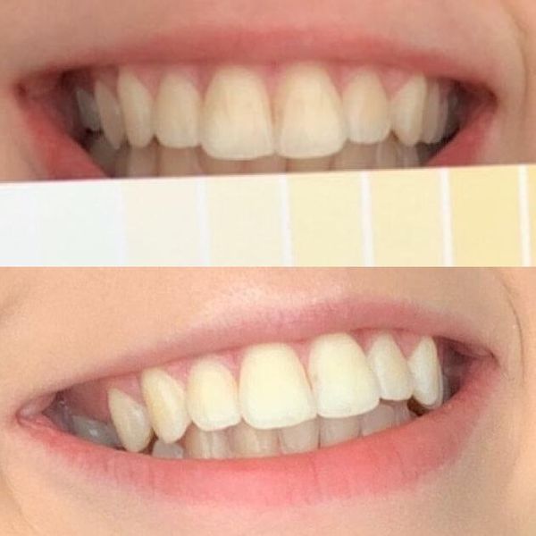 دستگاه سفید کننده دندان های اسمایل مدل 2022