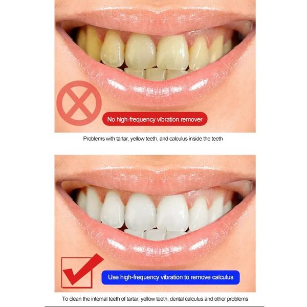 دستگاه شست و شو و جرم گیر دهان و دندان مدل JYQ-002